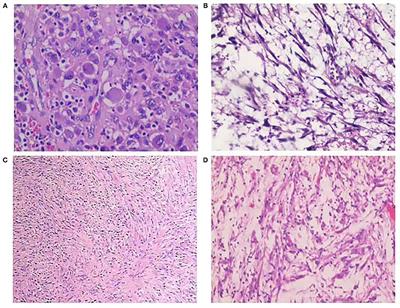 Inflammatory Myofibroblastic Tumor of the Urinary Bladder: An 11-Year Retrospective Study From a Single Center